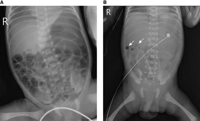 Case report: Catastrophic event: neonatal gastric perforation and complication of capillary leak syndrome